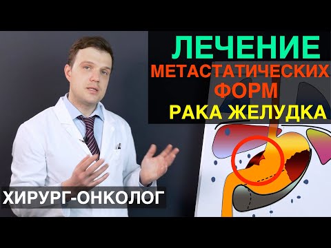 Рак желудка - лечение метастатических форм