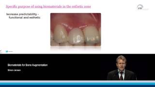 Biomaterials for Bone Augmentation | Simon Jensen