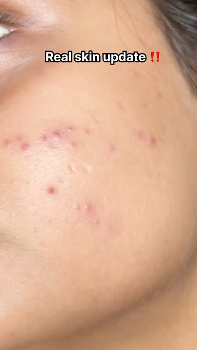 Acne prone skincare routine 🎀 #youtube #youtubeshorts #shoshou#skincafe #skin