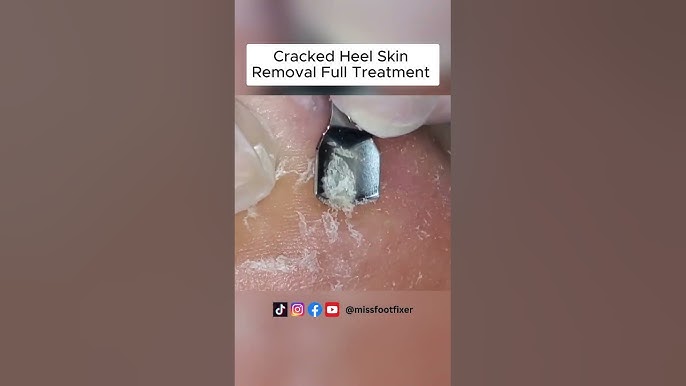 How To Remove Dead Skin From The Feet – My FootDr