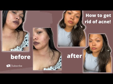 How to get RID of ACNE in just 4 WEEKS! | Daisy Roma