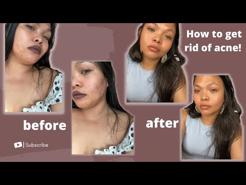 How To Get RID Of ACNE In Just 4 WEEKS! | Daisy Roma