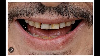 Johnny Depp rotting teeth standing ovation | Johnny Depp Flaunts Dental Makeover after rotting teeth