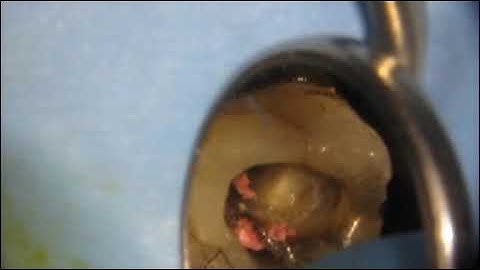 Removal of GP  POINTS FOR Re treatment