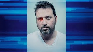 Man Places a Camera in His Eye Socket