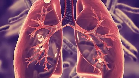 Everything you need to know about a LUNG NODULE, in 6 minutes