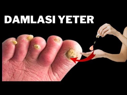 Damlası yeter ayak mantarı ve tırnak mantarına doğal çözüm sert topuklara iyi gelir