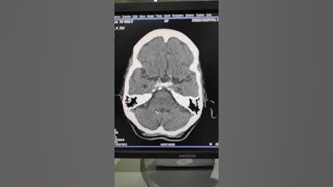 Artifact in CT scan images(16)