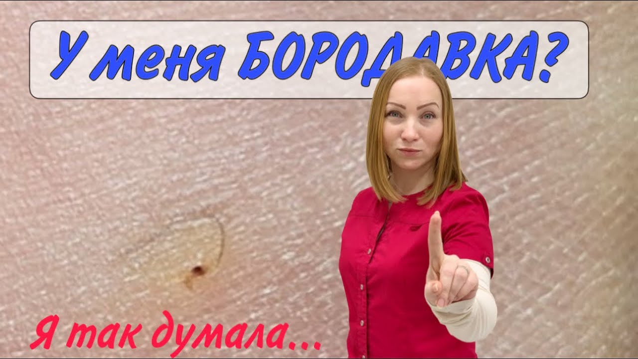 Вросший волос / бородавка на ноге / медицинский педикюр - YouTube