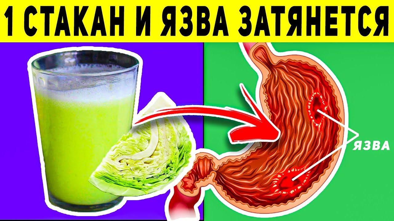 ВОТ ЧТО ТВОРИТ КАПУСТНЫЙ СОК! (Реальная Польза и Вред Капустного Сока)