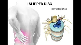 Disc Clinic BC | Slipped Herniated Disc Treatment Vancouver BC