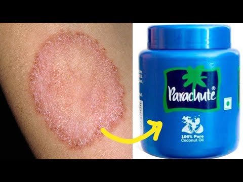 सिर्फ़ 2 दिन में दाद खाज खुजली (Eczema) को जड़ से खत्म कर देगा यह घरेलू नुस्खा Ringworm Treatment