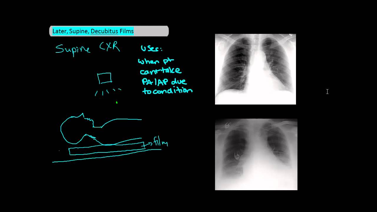 Active Cycle of Breathing Technique - Physiopedia