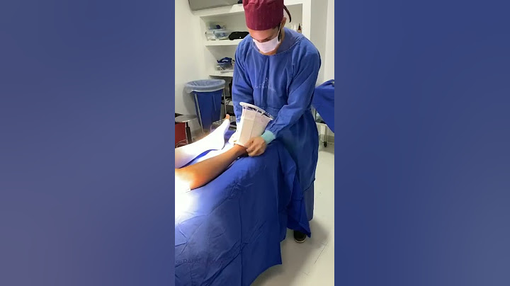 Cirurgia de Varizes  #shorts