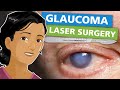 Glaucoma laser surgery