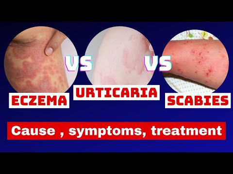 Eczema vs Urticaria vs Scabies | eczema | urticaria | scabies | skin disease