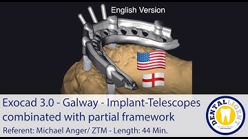 2021-Exocad 3.0 - TUTORIAL PREVIEW - Galway Implant-Telescopes combinated with partial framework