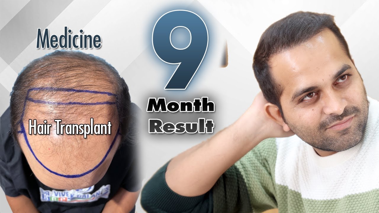 4000+ Grafts | Before After Hair Transplant Results| 26 years AGE | Dr. Vivek Galani | RQC