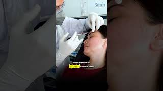 Are Dermal Fillers Permanent? | Celebre Aesthetics