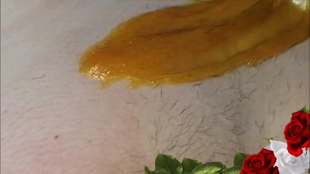 Видео женского шугаринга бикини. Бразильский шугаринг. Техническая аллергия на депиляцию сахарной пастой.