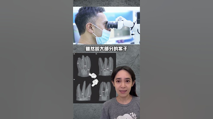 显微根管治疗自费2万多，值得吗🤔？#抽神经 - 天天要闻