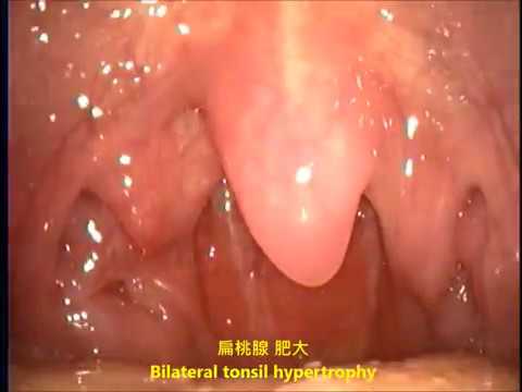 扁桃腺肥大與隱窩 鼻咽部腺樣體乳突樣外觀tonsil Hypertrophy Fossae Papillomatous Adenoid Youtube