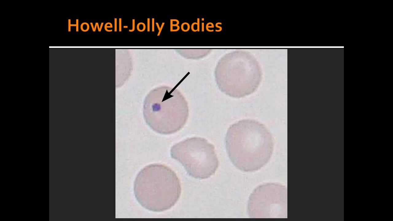 Red Blood Cell Disorder -- Heinz bodies, Howell-jolly bodies