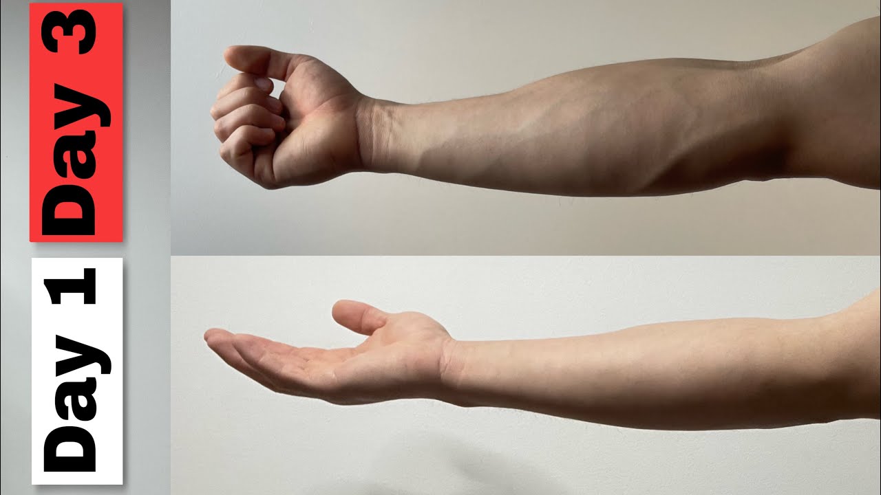 Getting Vascular arm DAY 3 - YouTube
