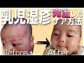 【3ヶ月】乳児湿疹が完治したケア方法～看護師ままの知識共有～ Three months old baby.
