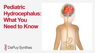 Pediatric Hydrocephalus and Shunt Surgery: What to Expect | DePuy Synthes