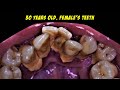 Crowding Teeth Will Increase Tartar Buildup | SCALING | Dentist | Dokter Gigi Tri Putra