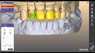 DESIGN COPING BRIDGE METALO CERAMIMC . DESIGN EXOCAD #43