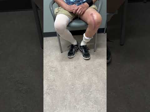 Knee Recovery After Traveling 100 Miles video thumbnail