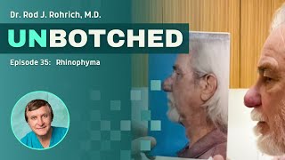 UNBOTCHED ep 35: Rhinophyma