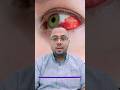 علاج النزيف الذي يحدث على بياض العين العيون العين نزيف 