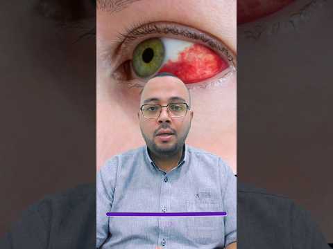 علاج النزيف الذي يحدث على بياض العين العيون العين نزيف
