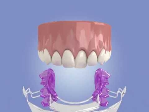 Video: Sú inman aligners odnímateľné?