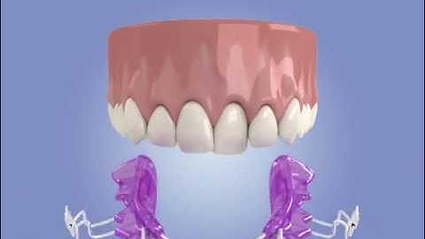 Inman Aligner - How it works