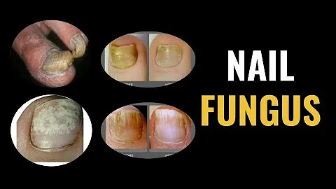 Nail Fungus - Dr. Donald Pelto - Worcester Podiatr...