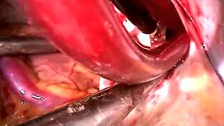 Removal of an Unusual Liver Tumor at the Cavoatrial Junction