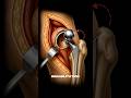 How Physical Therapy Restores Natural Walking Balance After Hip Post-Op #PainManagement #NYC #doctor