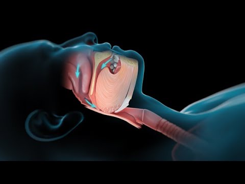 Vídeo: Los Efectos De La Apnea Del Sueño En El Cuerpo