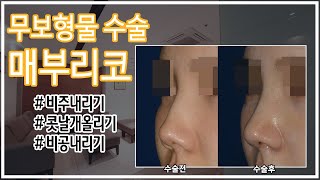보형물 없는 매부리코수술 (비공내리기+비주내리기+콧날개올리기) feat.전후사진