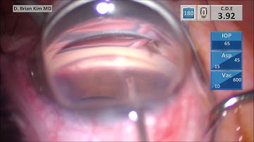 iStent inject W: What if 1st Stent Fails? Flush Technique. 2nd Stent Fails? Rethread & Dimple