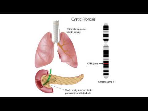 Kistik Fibrozis