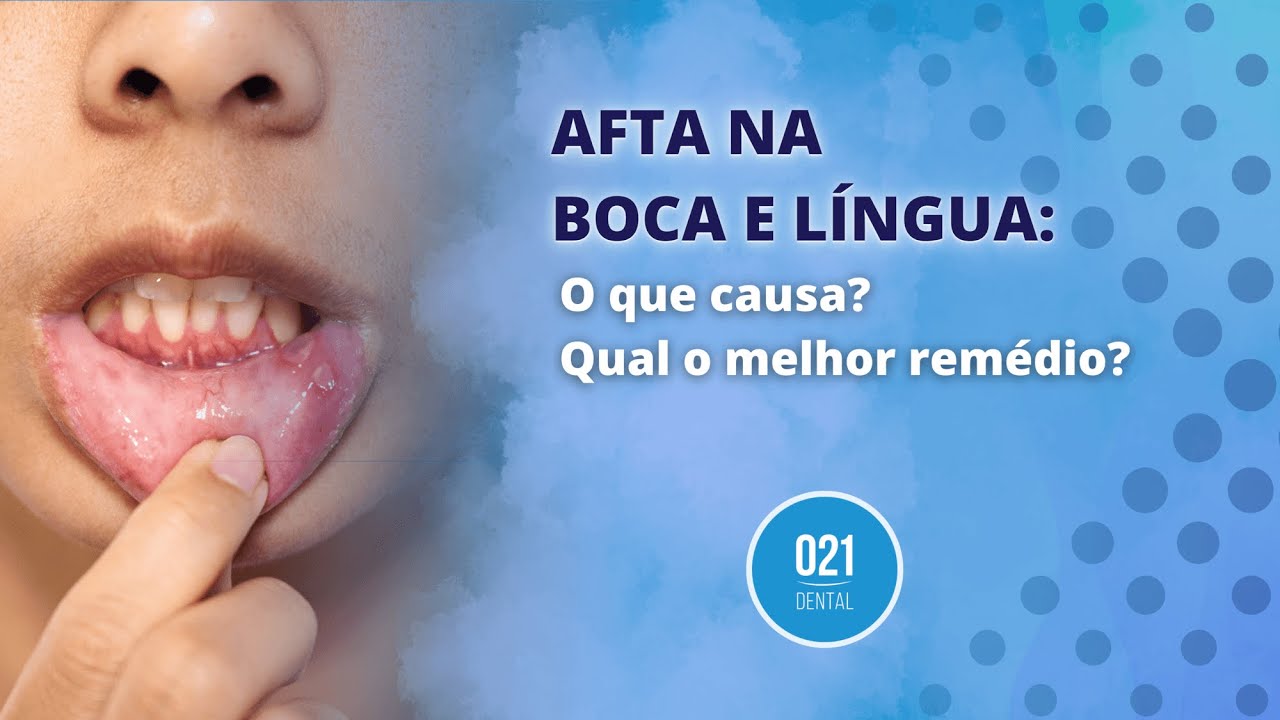 Afta na garganta: 7 principais causas (e o que fazer) - Tua Saúde