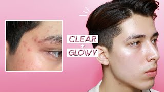 SECRETS TO CLEAR & GLOWY SKIN (bye acne)
