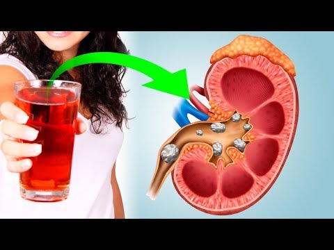 How to Cleanse & Detox Your Kidneys Naturally