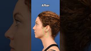 Testimonial for a patient that underwent the micro-parotidectomy to remove a benign parotid tumor.