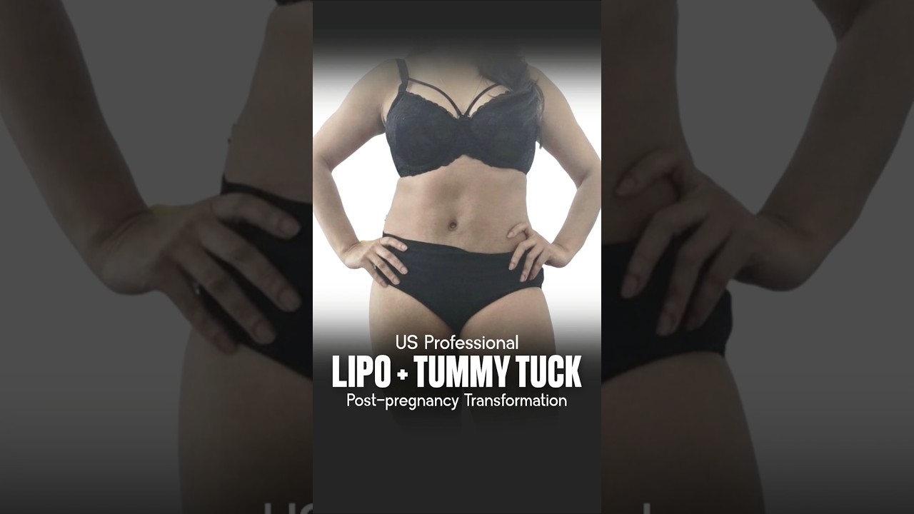 Struggling with Loose Skin After Pregnancy? See This Tummy Tuck & Lipo Transformation